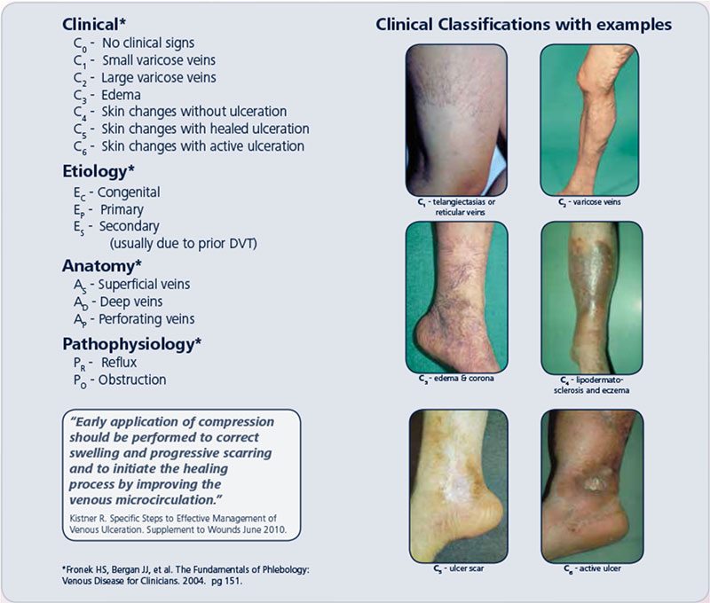 What is Venous Disease? Facts Everyone Should Know